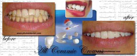 All ceramic crowns&bridges:Phuket Dentist,Thailand